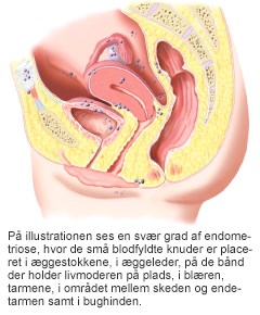 endometriose.jpg