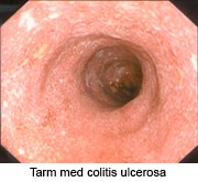 Colitis_ulcerosa.jpg