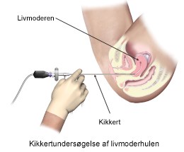 Kikkertundersoegelse_livmoderhulen.jpg