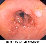 Crohns_sygdom.jpg