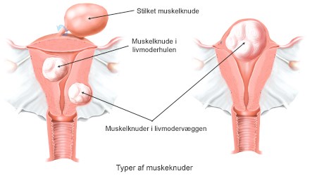 Muskelknuder_typer.jpg