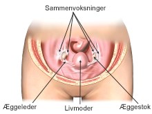 Sammenvoksninger_aeggeledere.jpg