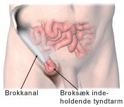 Lyskebrok – effektiv behandling Aleris