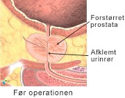 Prostata-foer-op.jpg