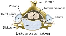 Diskusprolaps_nakke.jpg