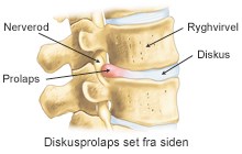 Diskusprolaps_fra_siden.jpg