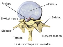 Diskusprolaps_ovenfra.jpg