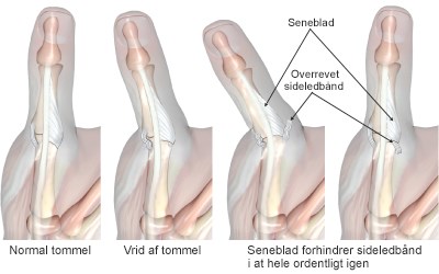 i tommelfinger | Aleris