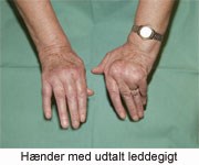 Leddegigt og fingre – få hjælp | Aleris