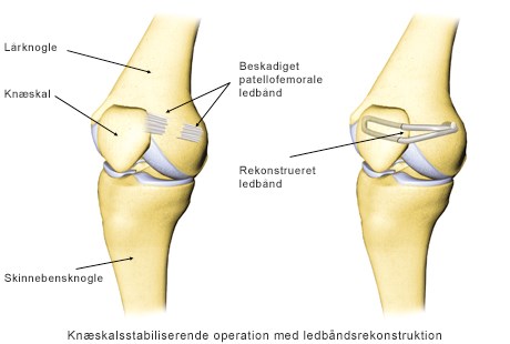 Knaeskalsstabiliserende_op.jpg