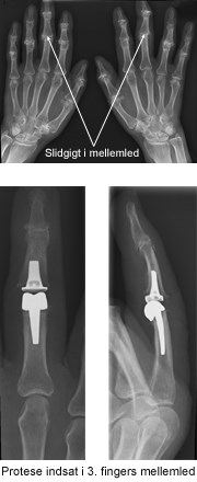 Træ mus professionel Slidgigt i fingrene – bedre livskvalitet | Aleris