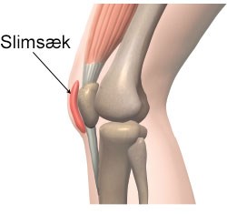 Slimsækbetændelse – Få Aleris