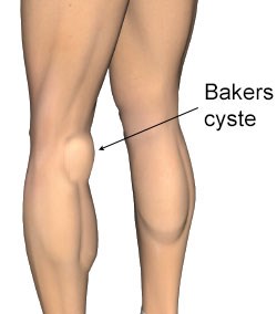 Baker_cyste_250px.jpg