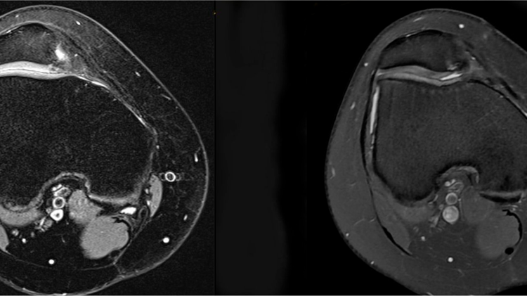 Arthroscopic Trochleoplasty wide_2.png