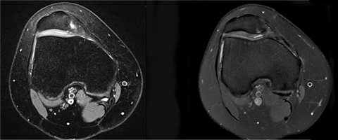 Arthroscopic Trochleoplasty wide_2.png